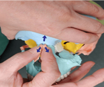 Suture Traction Therapy at the frontonasal suture: one hand on the frontal bone, thumbs pulling at the nasion and radix